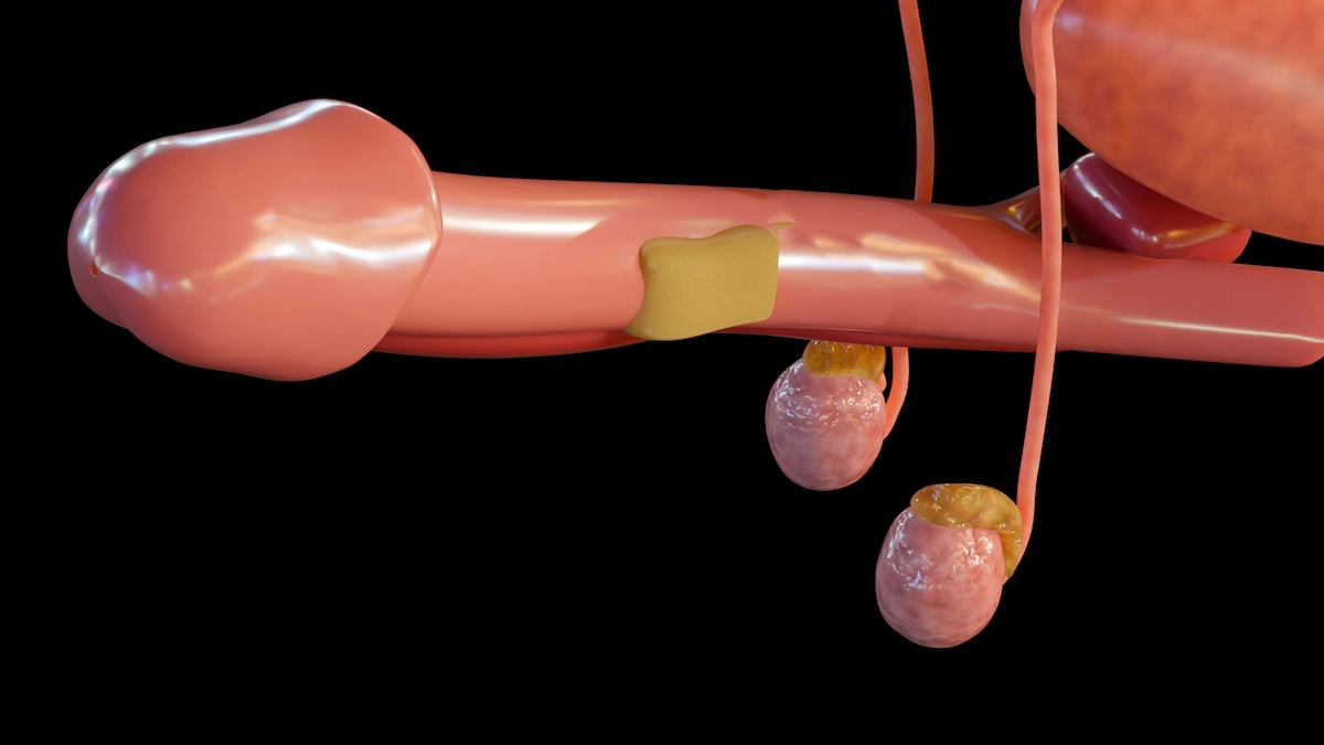 Fase inflamatoria peyronie